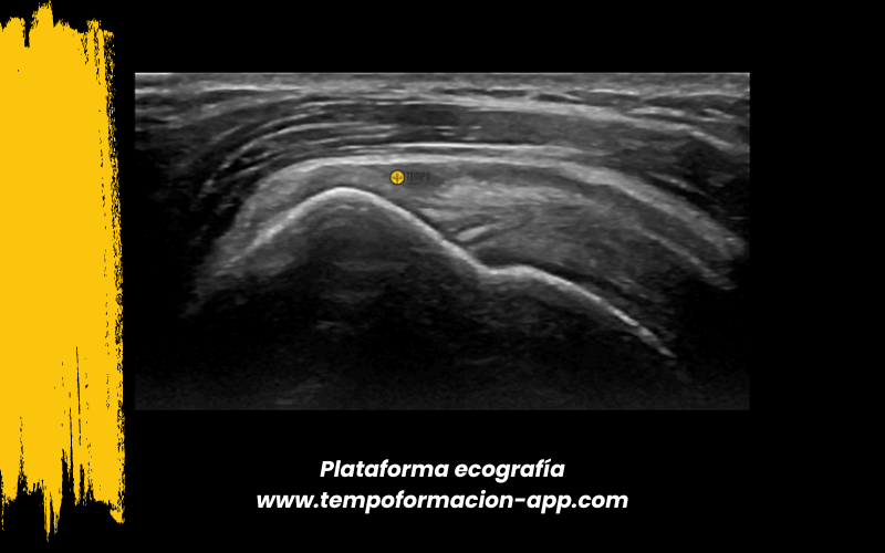 3. Ecografia tempo formacion manguito rotador tendon supraespinoso infraespinoso redondo menor subescapular.png